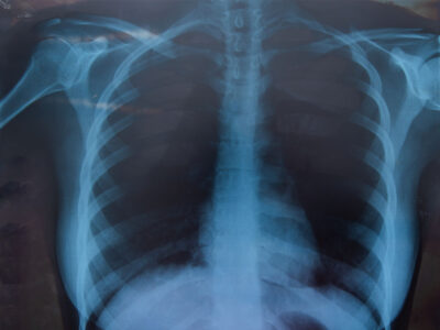 Localización de Estructuras Anatómicas para TES